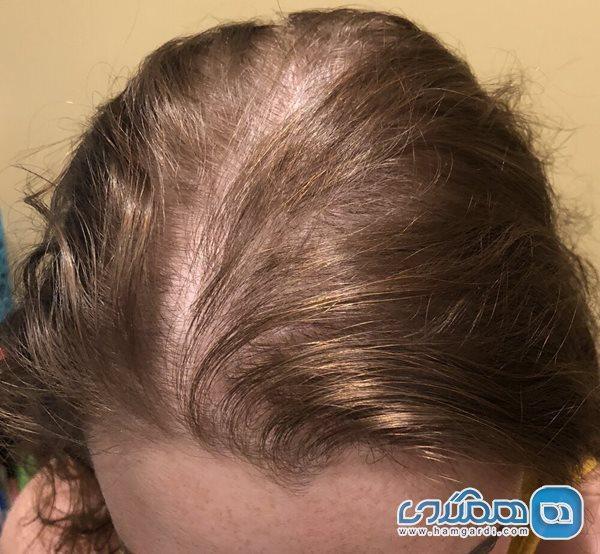 چرا خانم ها دچار ریزش مو می شوند؟ چرا خانم ها دچار ریزش مو می شوند؟